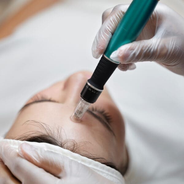 Microdermabrasion